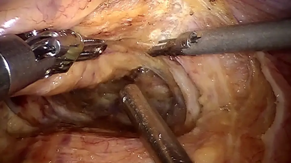 Robot-assisted Total Mesorectal Excision and Lateral Pelvic Lymph Node Dissection for Locally Advanced Middle-low Rectal Cancer