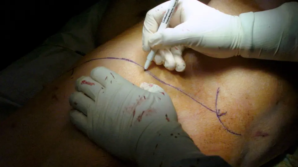 Left Lung Orthotopic Transplantation in a Juvenile Porcine Model for ESLP