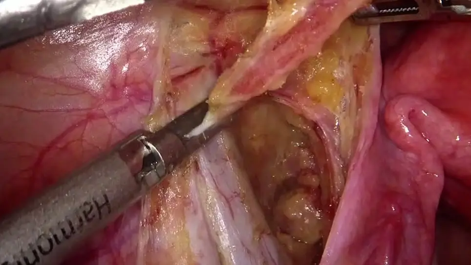 Sentinel Lymph Node Mapping and Biopsy for Endometrial Cancer at Early Stage with Laparoscopy