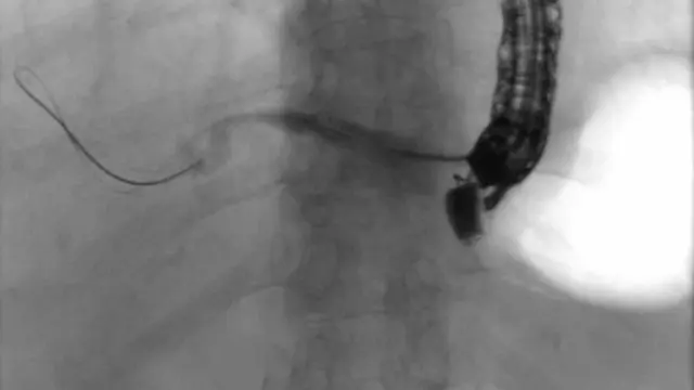 Endoscopic Ultrasound-Guided Biliary Drainage: Endoscopic Ultrasound-Guided Hepaticogastrostomy in Malignant Biliary Obstruction