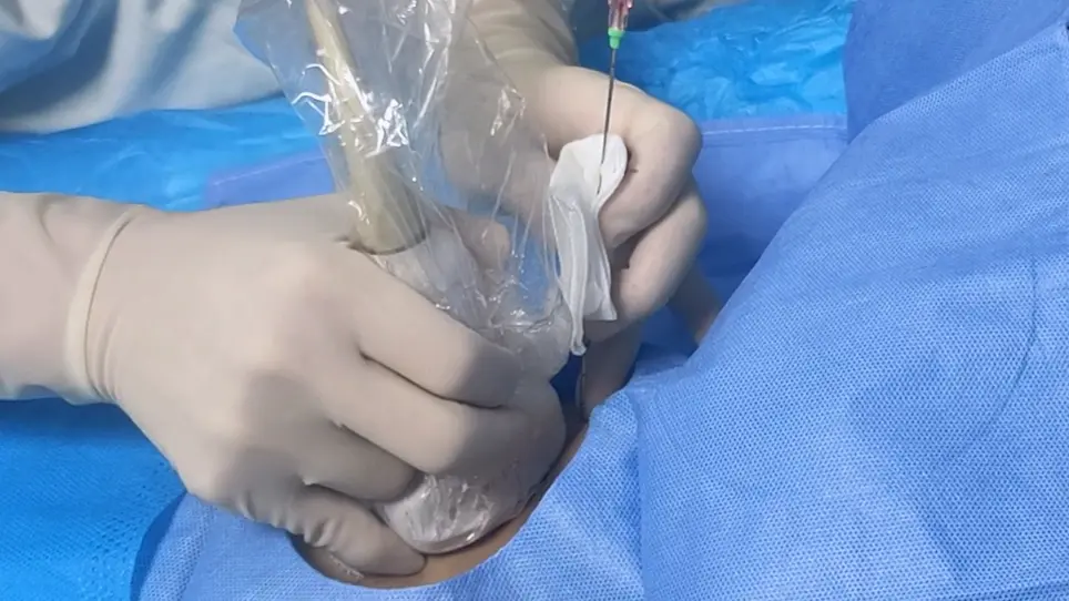 A Two-Step Method for Percutaneous Transhepatic Choledochoscopic Lithotomy