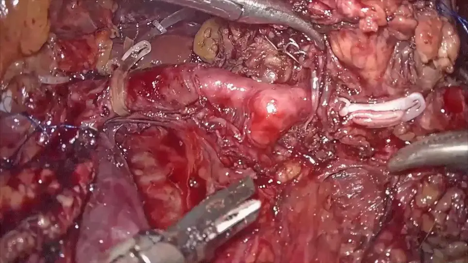 Laparoscopic Radical Antegrade Modular Pancreatosplenectomy <em>via</em> Dorsal-Caudal Artery Approach for Pancreatic Neck-Body Cancer