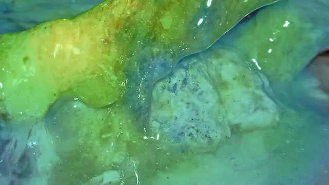 Indocyanine Green-Guided Intraoperative Imaging to Facilitate Video-Assisted Retroperitoneal Debridement for Treating Acute Necrotizing Pancreatitis