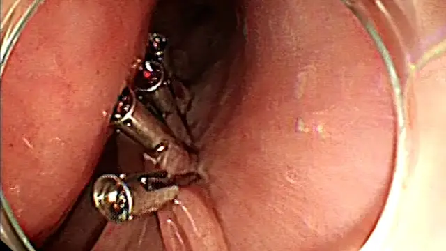 Use of the Scissor-Type Knife During the Peroral Endoscopy Myotomy Procedure for the Treatment of Achalasia