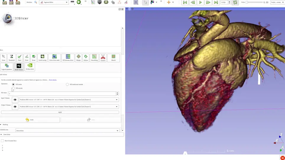 Four-Dimensional Computed Tomography-Guided Valve Sizing for Transcatheter Pulmonary Valve Replacement