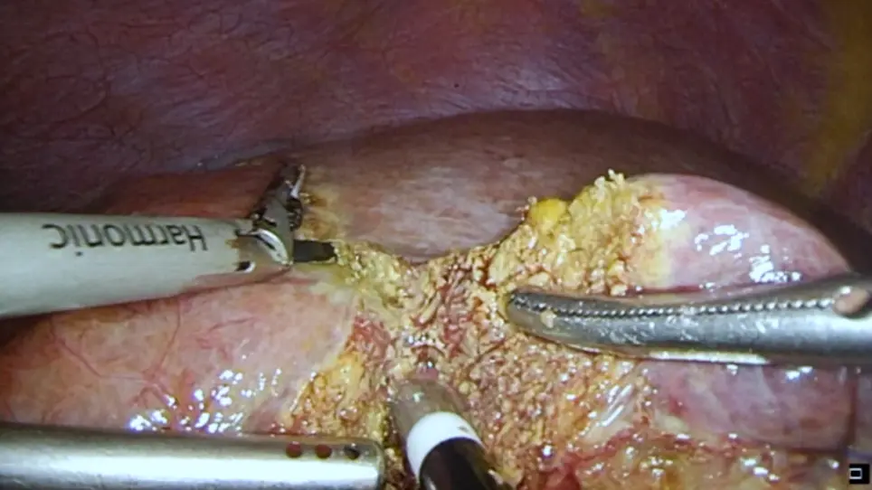 Application of Hemostatic Devices in Laparoscopic Hepatectomy