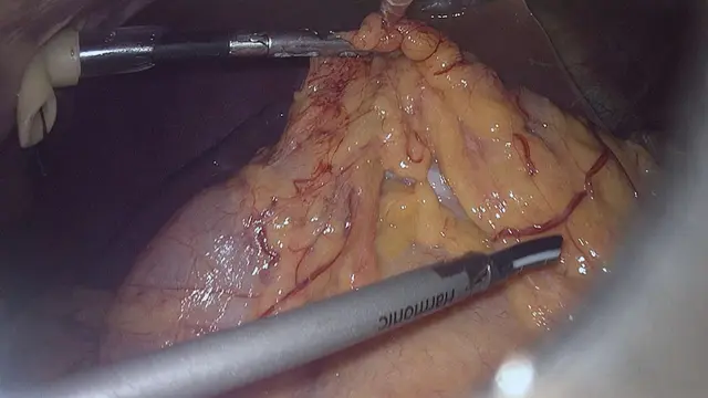 Laparoscopic Pancreatoduodenectomy for Pancreatic Cancer Using <em>In-Situ</em> No-Touch Isolation Technique