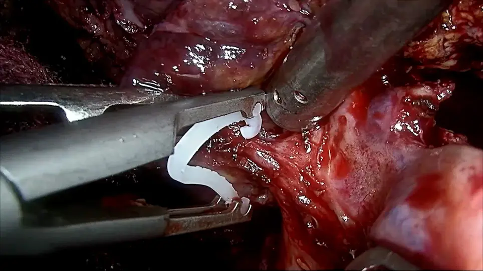 Modified Laparoscopic Anatomic Hepatectomy: Two-Surgeon Technique Combined with the Simple Extracorporeal Pringle Maneuver