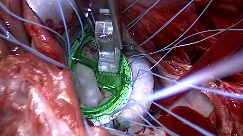 Cox-Maze IV Procedure Concomitant with Valvular Surgery In Situs Inversus Dextrocardia: A Single-Center Experience in China