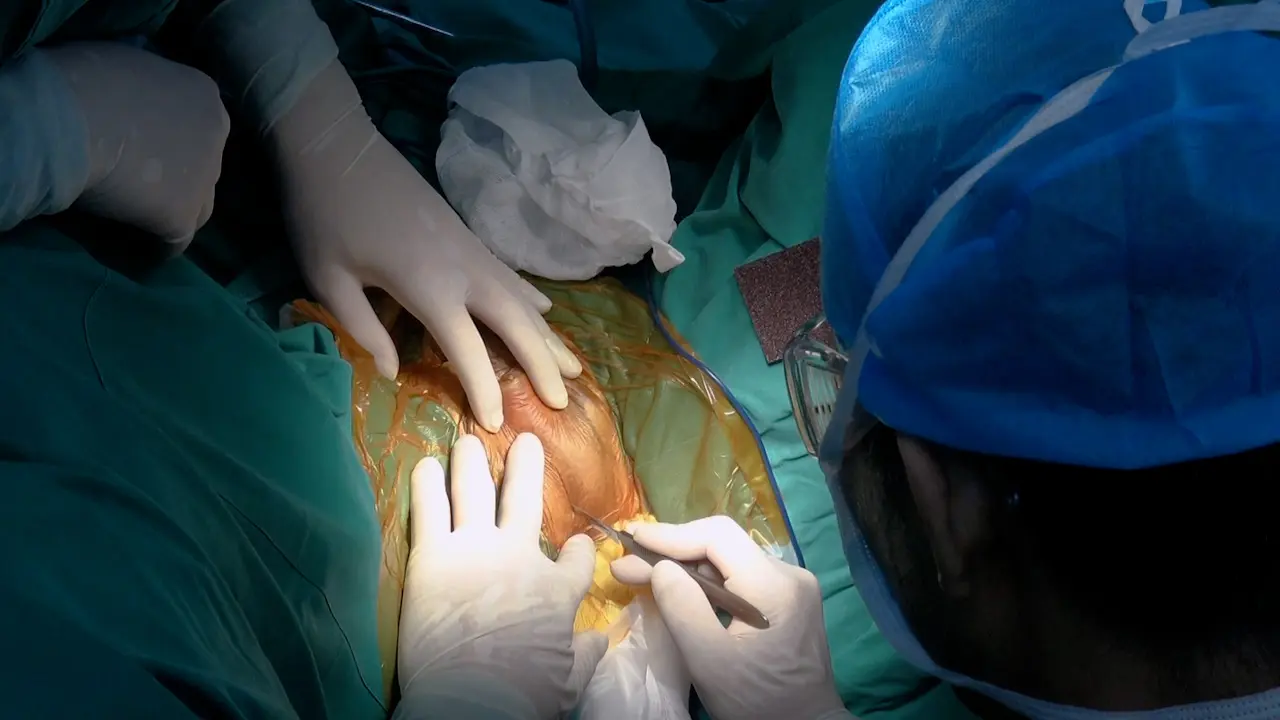 Transcorporal Artificial Urinary Sphincter Cuff Placement in a Case Requiring Revision for Urethral Atrophy