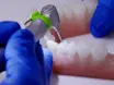 Dynamic Navigation in Endodontics: Guided Access Cavity Preparation by Means of a Miniaturized Navigation System