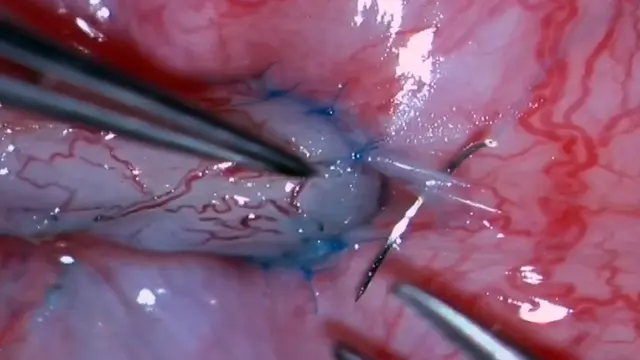Vessel-Sparing Microsurgical Longitudinal Intussusception Vasoepididymostomy to Treat Epididymal Obstructive Azoospermia