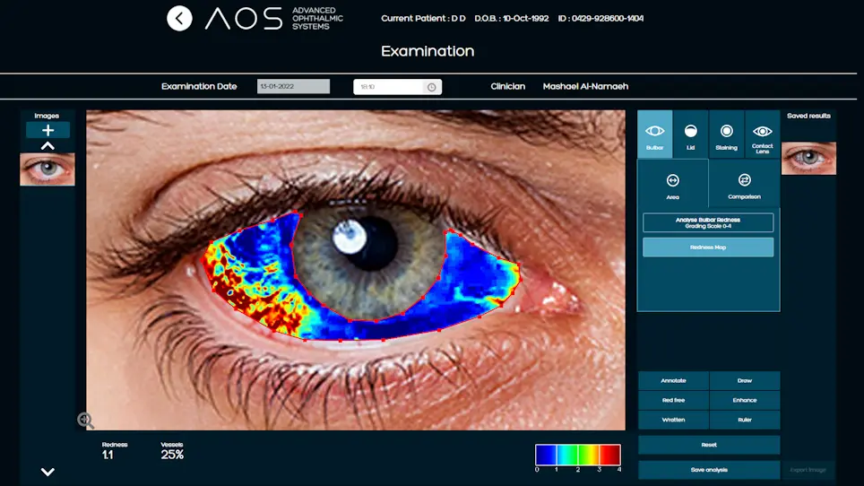 Comparing Objective Conjunctival Hyperemia Grading and the Ocular Surface Disease Index Score in Dry Eye Syndrome During COVID-19