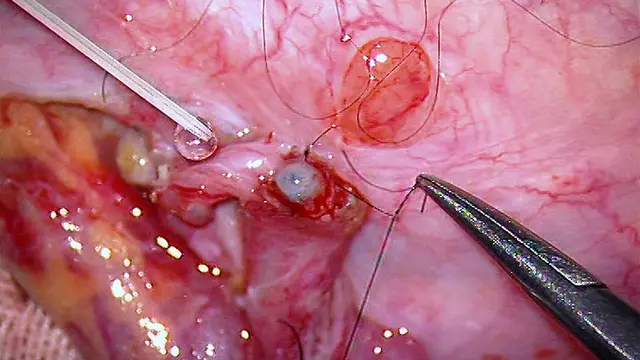 A Modified Vessel-Sparing Microsurgical Vasoepididymostomy