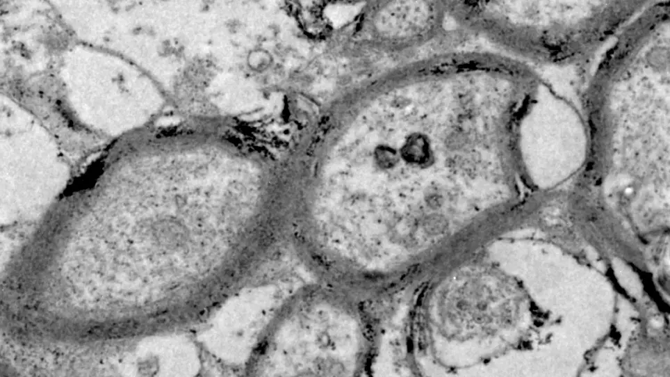 A Stably Established Two-Point Injection of Lysophosphatidylcholine-Induced Focal Demyelination Model in Mice