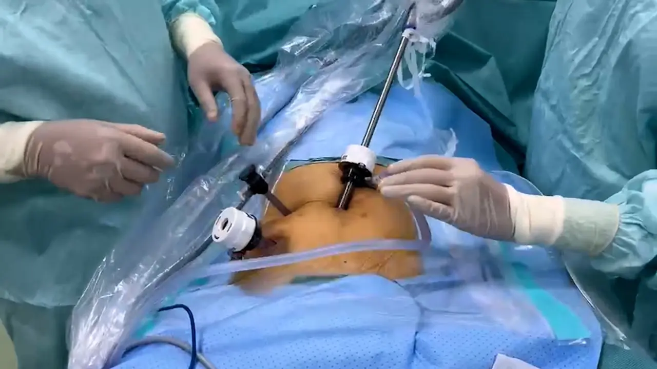 Clinical Application of Single-Surgeon, Three-Port, Laparoscopic Resection for Colorectal Cancer with Natural Orifice Specimen Extraction