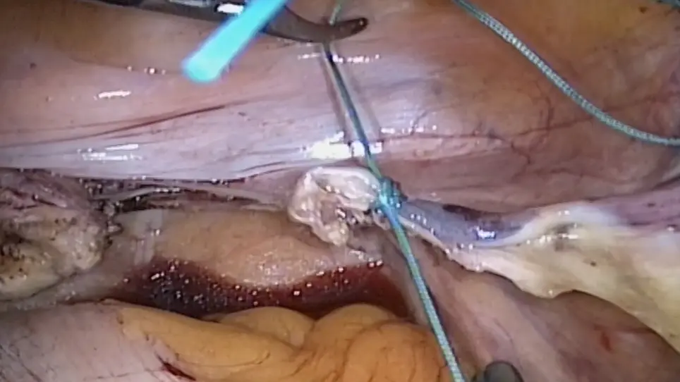 Laparoscopic Non-Mesh Cerclage Pectopexy for Pelvic Organ Prolapse