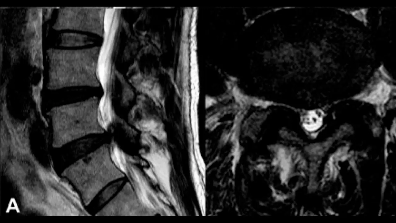 Full-Endoscopic Interlaminar Approach for Decompression of Lateral Recess Stenosis