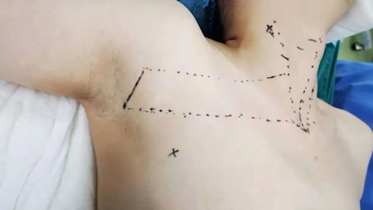 Gasless Endoscopic Thyroidectomy <em>via</em> the Trans-Axillary Approach