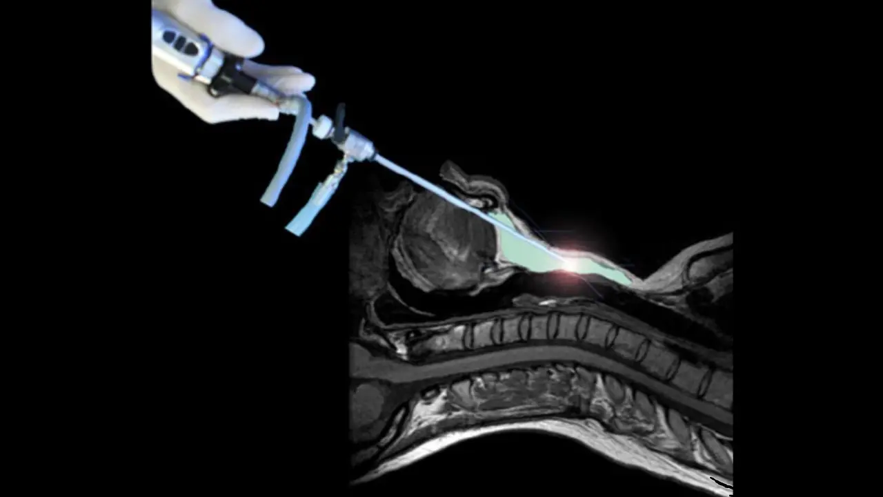 Transoral Robotic Total Thyroidectomy and Bilateral Central Regional Lymph Node Dissection for Papillary Thyroid Carcinoma