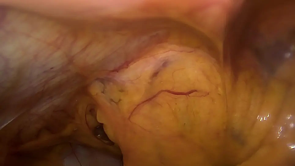 Laparoscopic Common Bile Duct Exploration in Patients with a Previous History of Biliary Tract Surgery