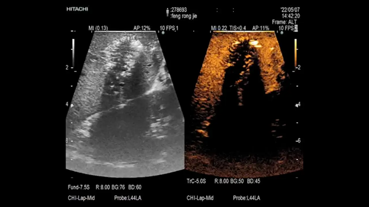 Application of Laparoscopic Hepatectomy Combined with Intraoperative Microwave Ablation in Colorectal Cancer Liver Metastasis