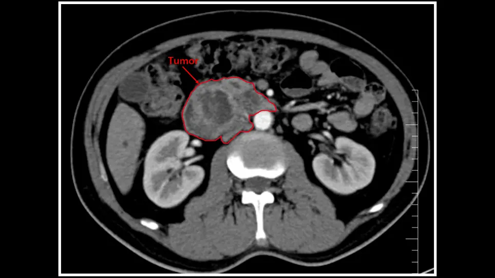 Management of the Uncinate Process in No-Touch Laparoscopic Pancreaticoduodenectomy