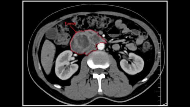 Management of the Uncinate Process in No-Touch Laparoscopic Pancreaticoduodenectomy