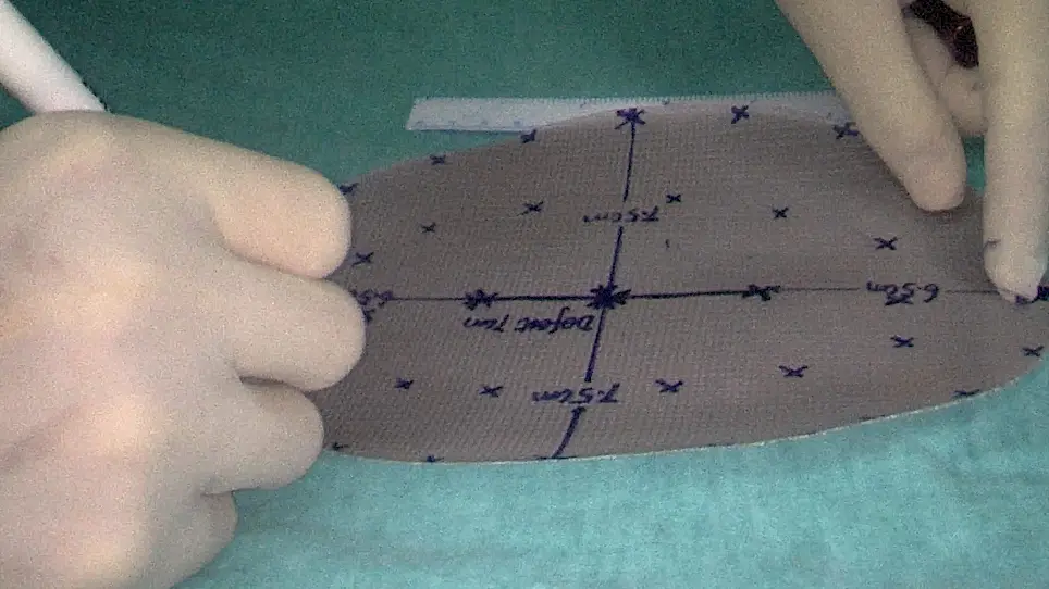 Application of a New Mesh Fixation Method in Laparoscopic Incisional Hernia Repair