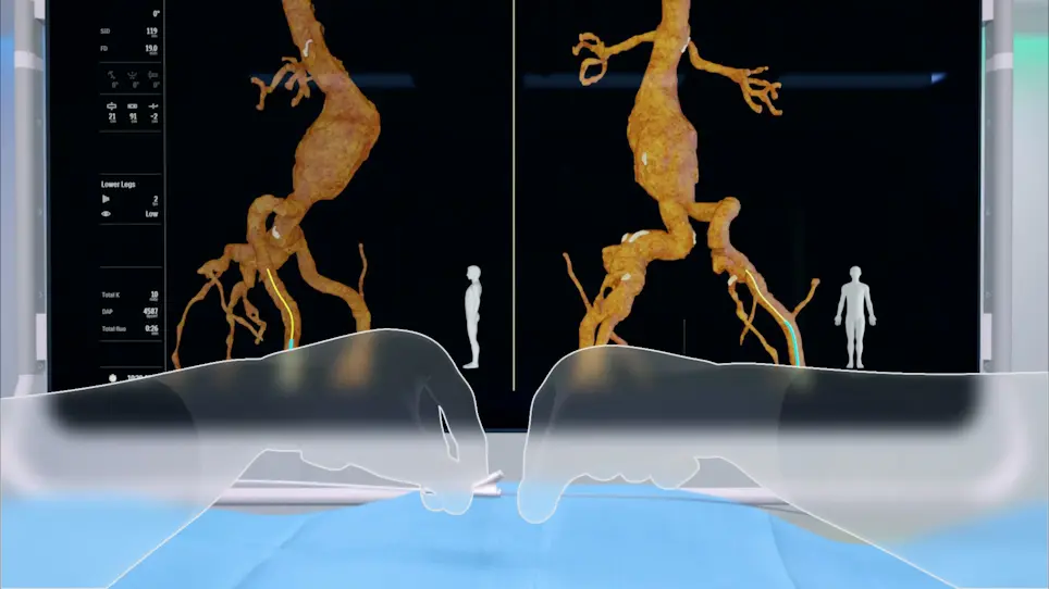 Reduction of Radiation Exposure during Endovascular Treatment of Peripheral Arterial Disease Combining Fiber Optic RealShape Technology and Intravascular Ultrasound