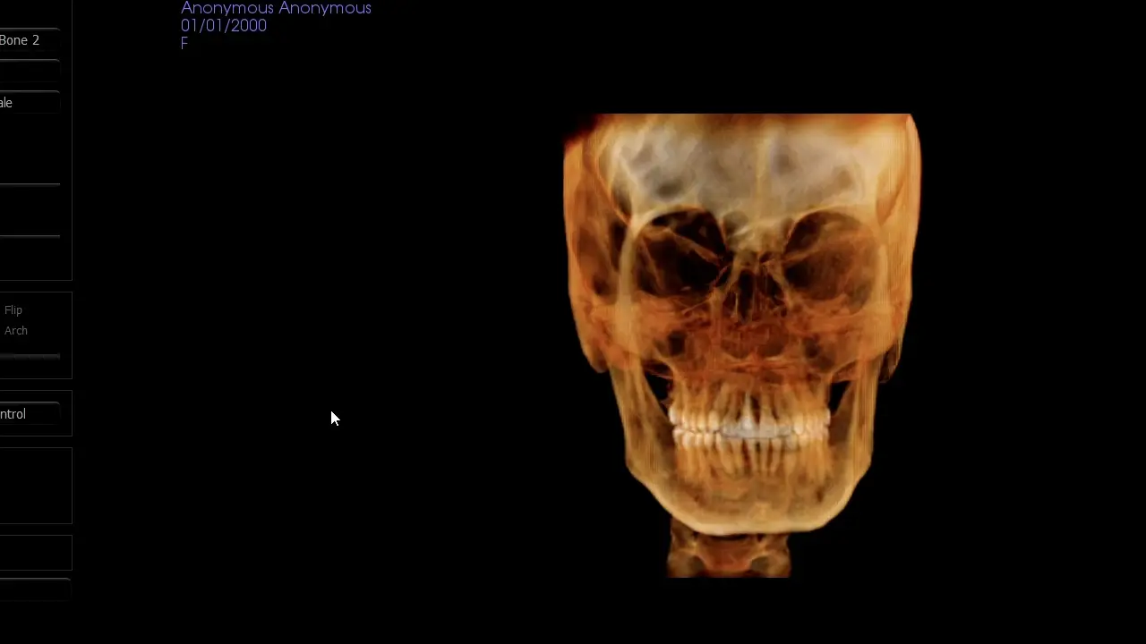 Three-Dimensional Cephalometric Landmark Annotation Demonstration on Human Cone Beam Computed Tomography Scans