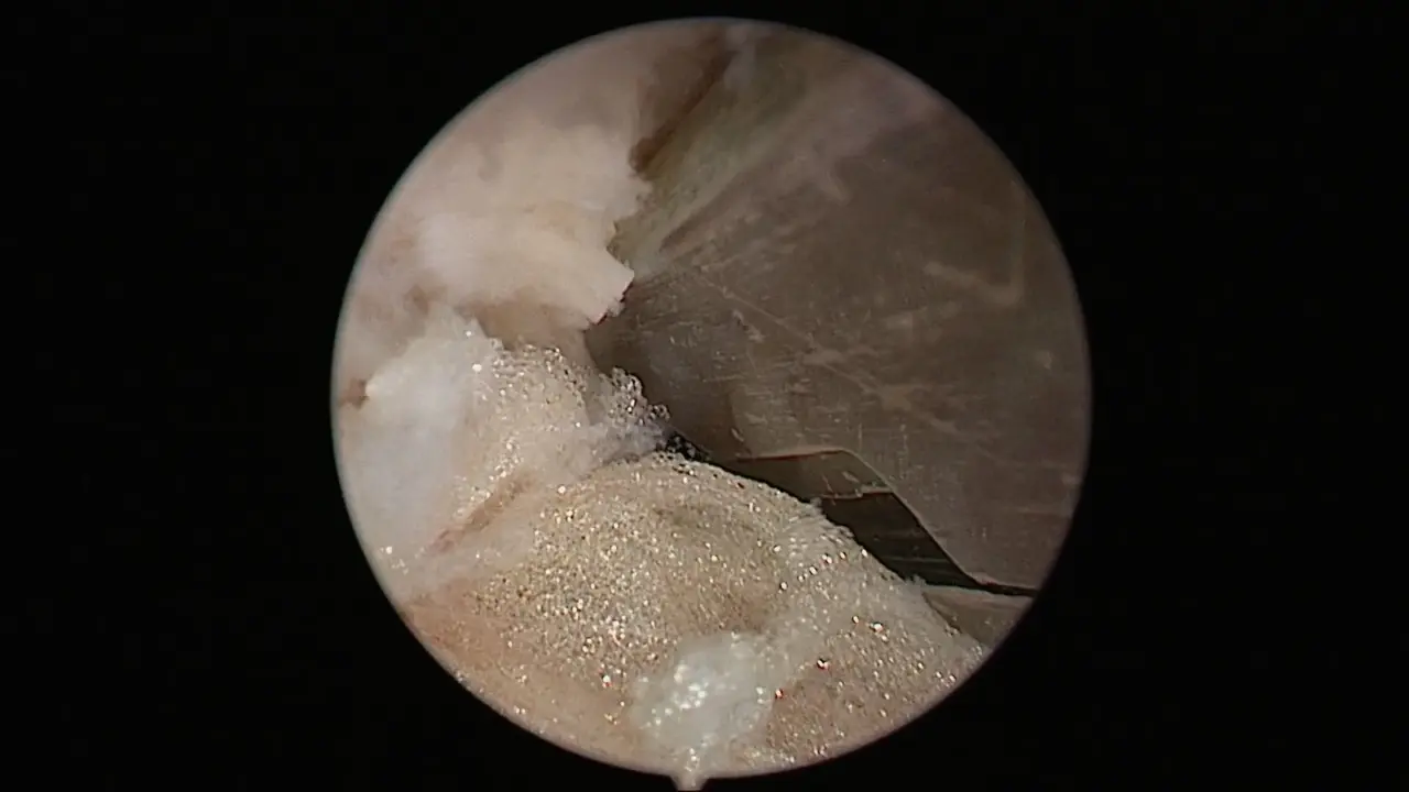 The Third Channel-Assisted Unilateral Biportal Endoscopic Technique for Lumbar Spinal Stenosis Combined with Contralateral Disc Herniation