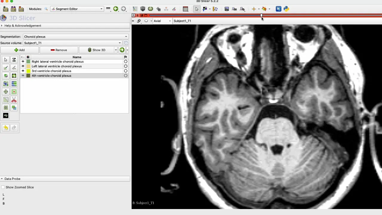 Manual Segmentation of the Human Choroid Plexus Using Brain MRI