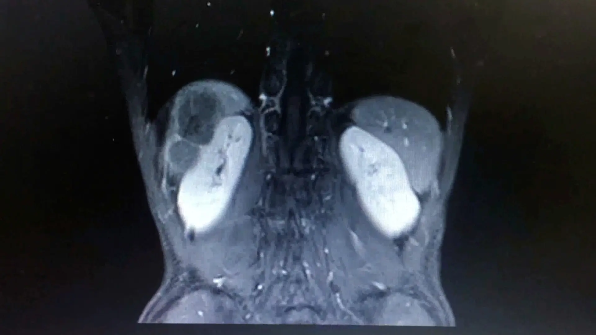 Laparoscopic Anterior Right Hepatectomy: A Single-Center Experience