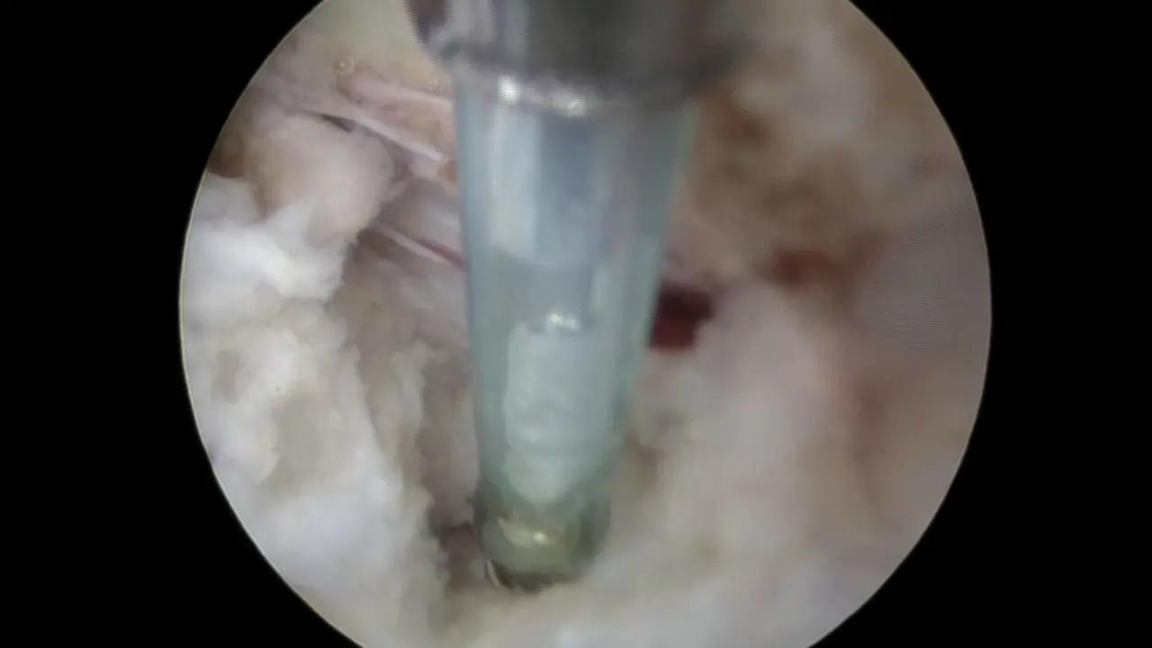 Full-Endoscopic Transforaminal Approach for Lumbar Discectomy