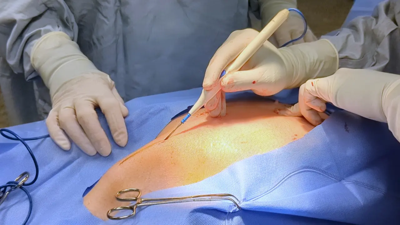 Surgical Porcine Model of Chronic Myocardial Ischemia Treated by Exosome-laden Collagen Patch and Off-pump Coronary Artery Bypass Graft
