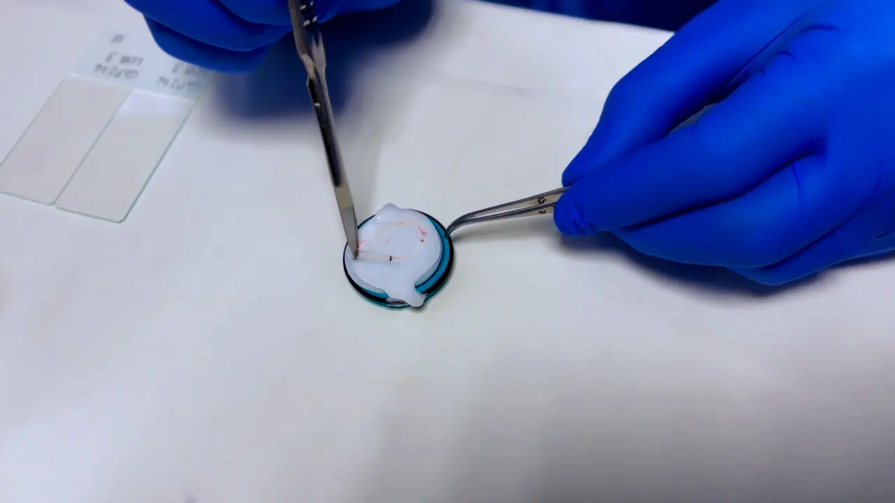 Enhancing Prostate Tumor Biobanking Reliability with Improved Sampling Technique and Histological Characterization