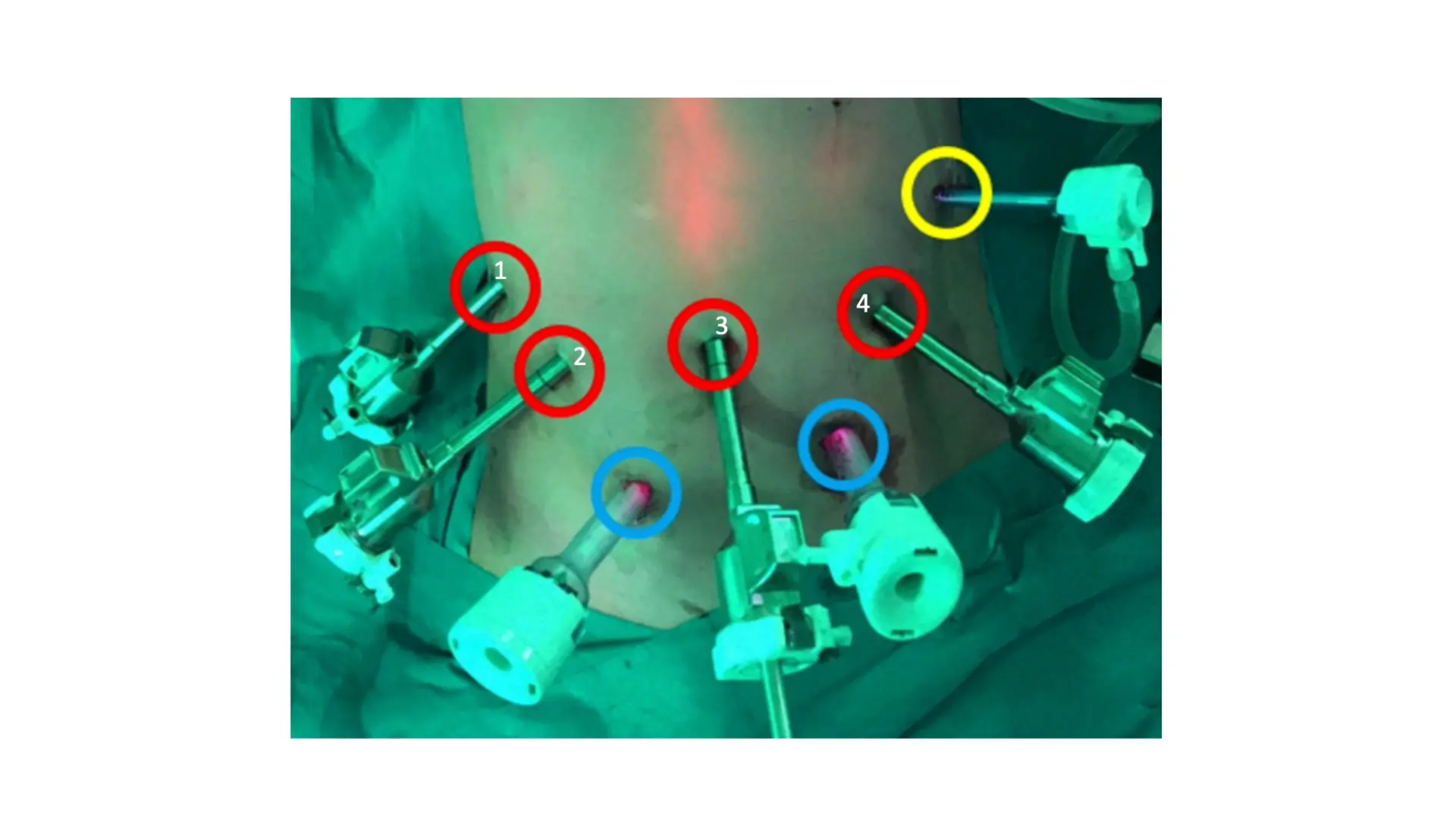 Robotic D3 Partial Duodenal Resection with Primary Side-to-Side Anastomosis