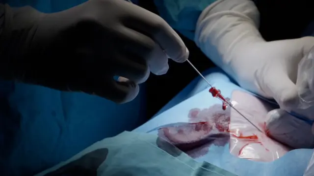 A Minimally Invasive Model of Aortic Stenosis in Swine