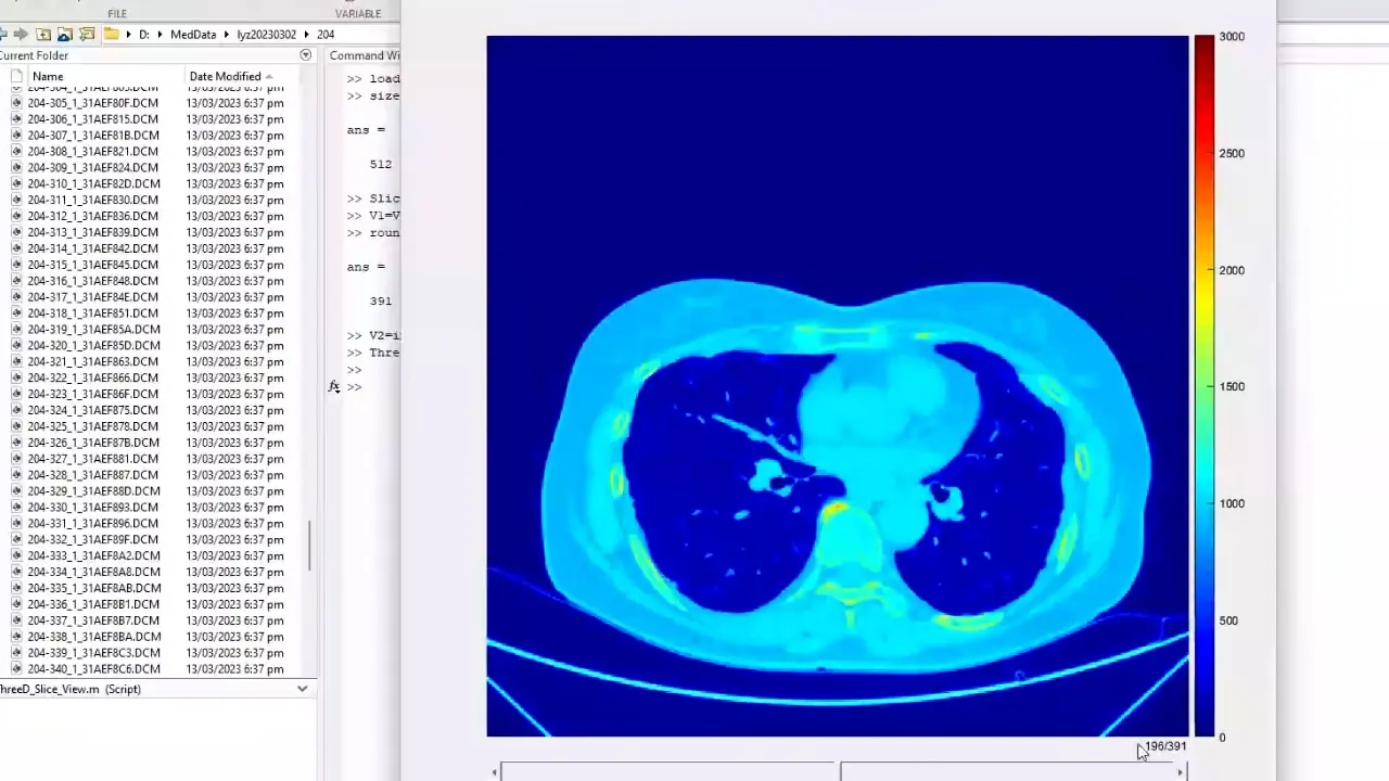 Three-Dimensional Reconstruction for the Whole Lung with Early Multiple Pulmonary Nodules