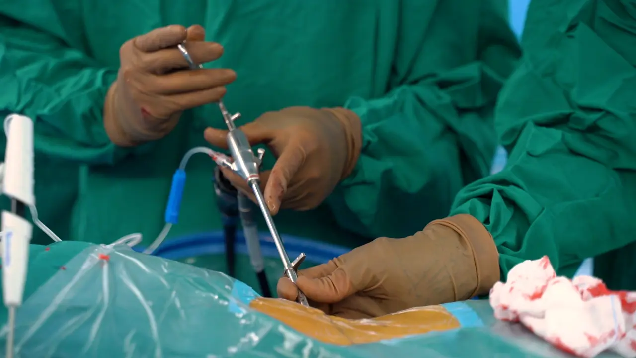 A Suture Technique for Ruptured Annulus Fibrosus Following Decompression Under Percutaneous Transforaminal Endoscopic Discectomy
