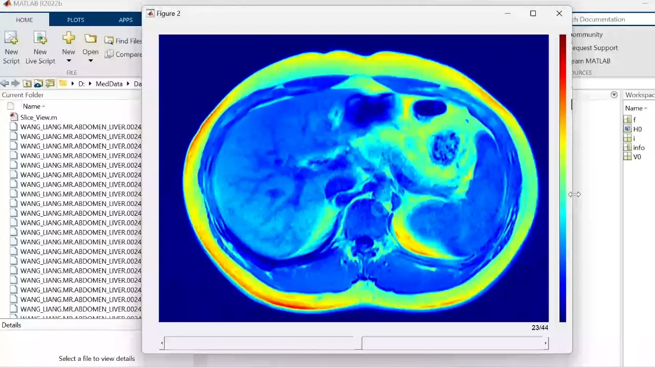 A 3D Quantification Technique for Liver Fat Fraction Distribution Analysis Using Dixon Magnetic Resonance Imaging