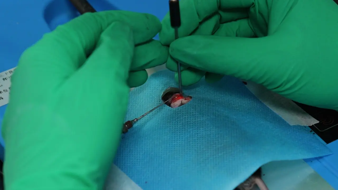 Induction of Acute Ischemic Stroke in Mice Using the Distal Middle Artery Occlusion Technique