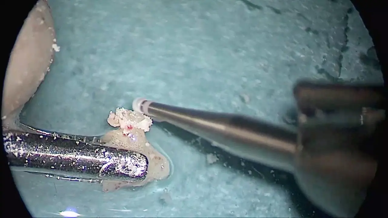 Techniques of Endoscopic Ossiculoplasty