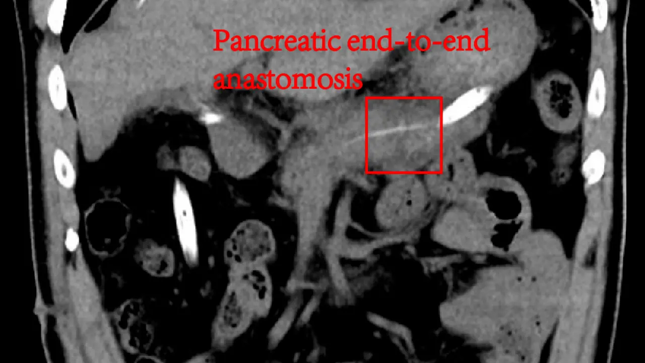 Application of Mid-Pancreatectomy with End-to-End Anastomosis in Pancreatic Benign Tumors