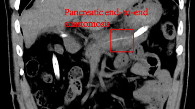 Application of Mid-Pancreatectomy with End-to-End Anastomosis in Pancreatic Benign Tumors