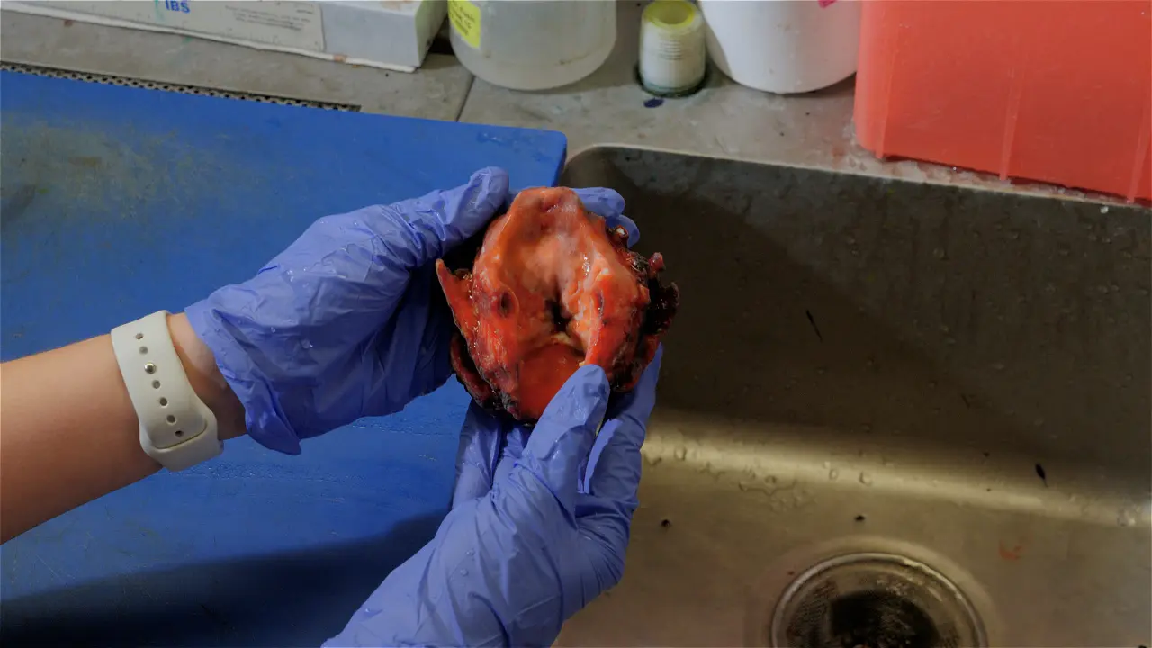 Enhanced Communication of Tumor Margins Using 3D Scanning and Mapping