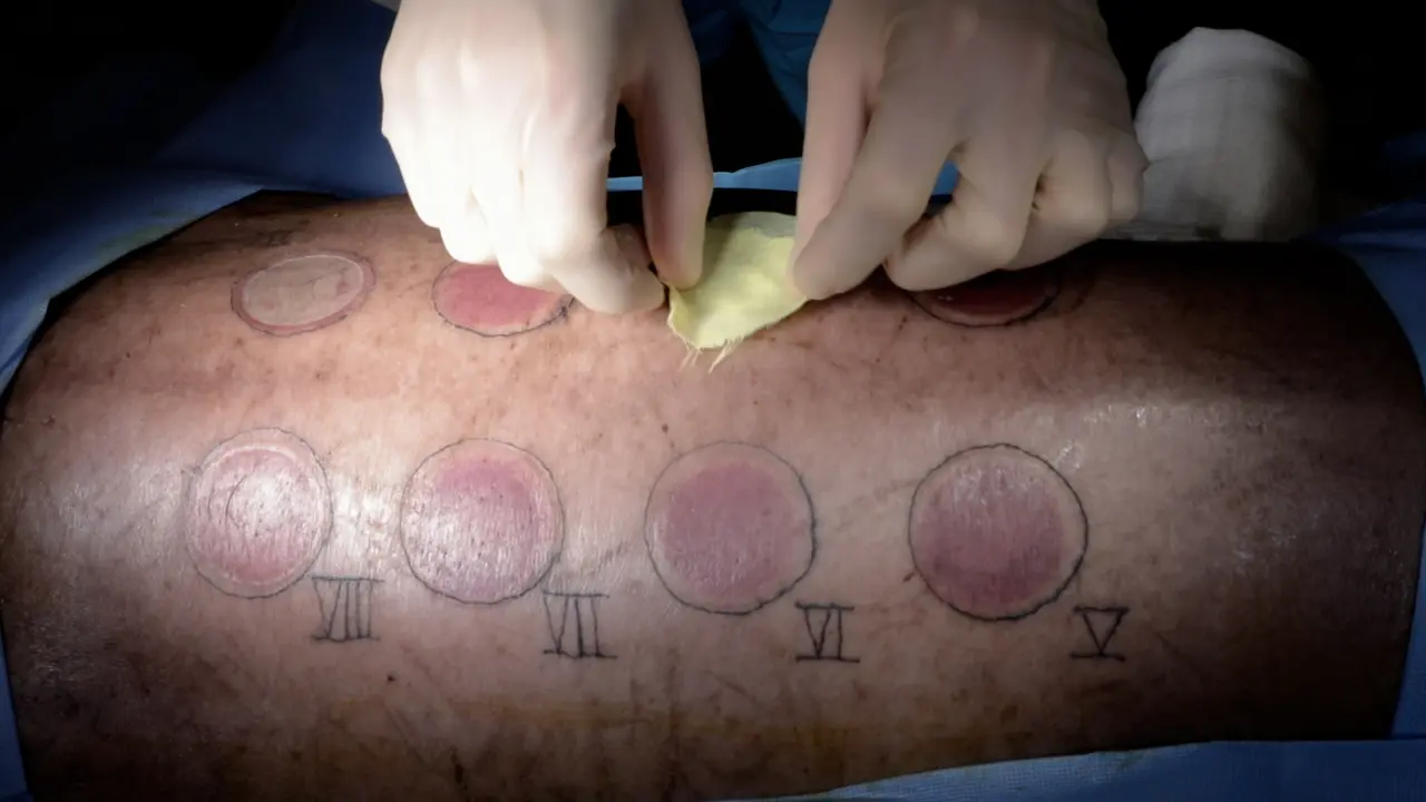 A Swine Burn Model for Investigating the Healing Process in Multiple Depth Burn Wounds