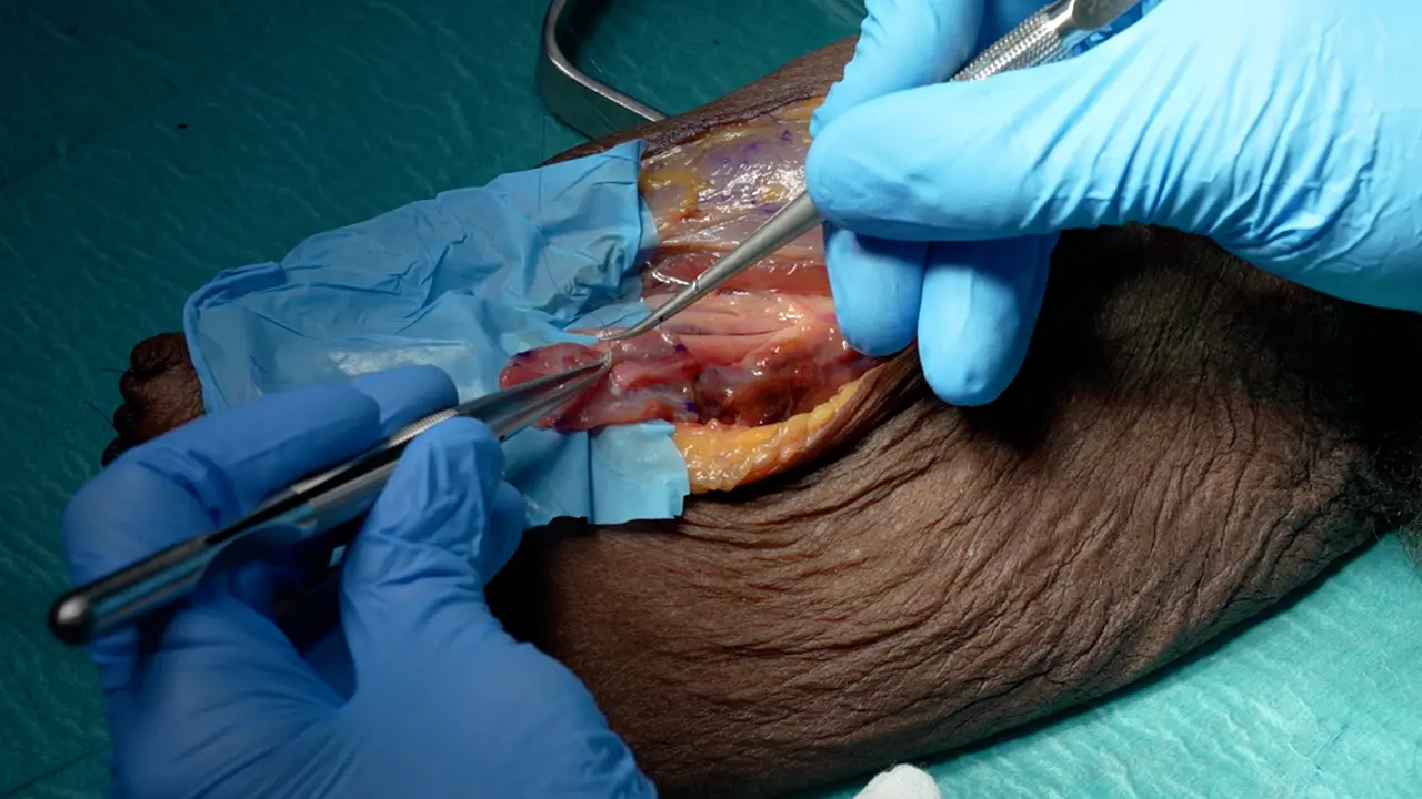 Regenerative Peripheral Nerve Interface: Surgical Protocol for a Randomized Controlled Trial in Postamputation Pain