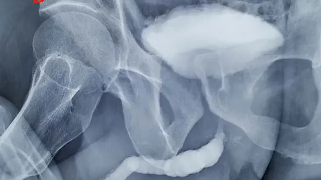 Urethroplasty with Pedicled Tunica Vaginalis for the Treatment of Long-segment Anterior Urethral Stricture Caused by Lichen Sclerosus of Glans Penis